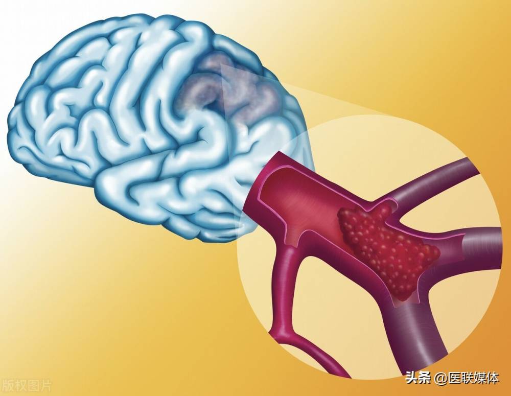 脑梗和脑溢血是一种病吗?糖尿病会导致死亡吗?一文解答